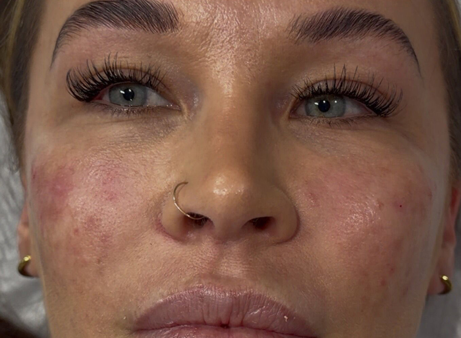 Close-up of a person's face with visible skin conditions