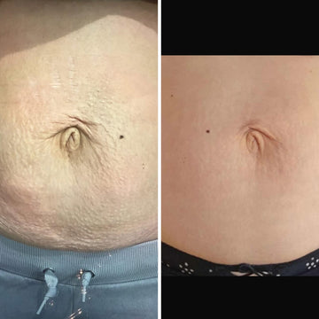 Before and after comparison of a person's stomach skin texture.