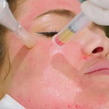 Close-up of a person receiving a facial treatment with a laser device.