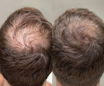 H&B - Hair Growth Package