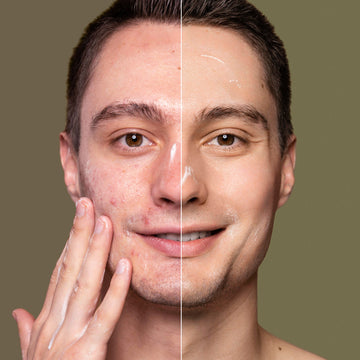Before and after comparison of a man's face with acne on one side and clear skin on the other, against a brown background.
