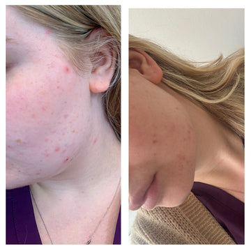 Before and after comparison of a person's neck and shoulder area with visible acne.