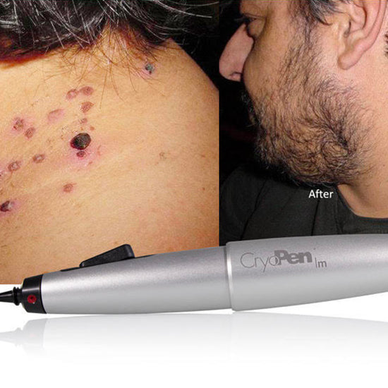 Before and after comparison of a skin treatment device on a person's skin.