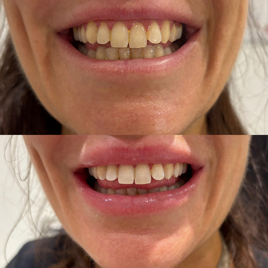 Before and after comparison of a person's teeth with dental treatment.