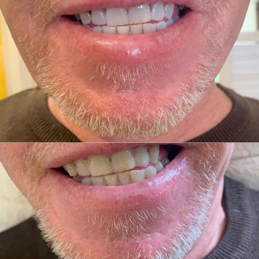 Before and after comparison of a person's teeth with dental treatment.